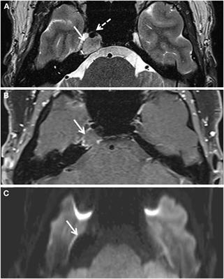 Sixth Nerve Palsy from Cholesterol Granuloma of the Petrous Apex